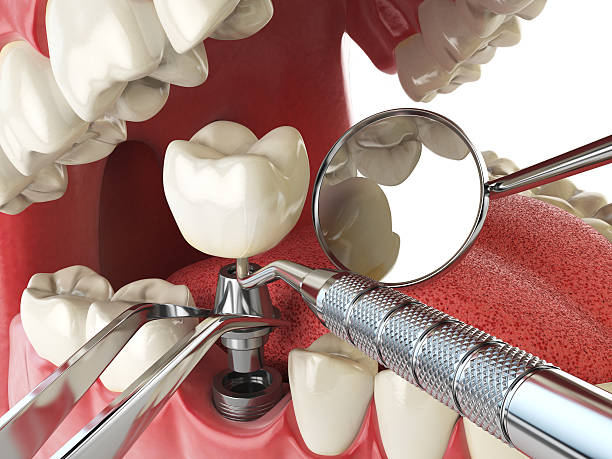Best Emergency Dentist for Lost Fillings or Crowns in Silverton, OH